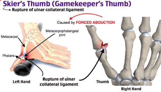 Healing Thumb Issues Before they Become Chronic