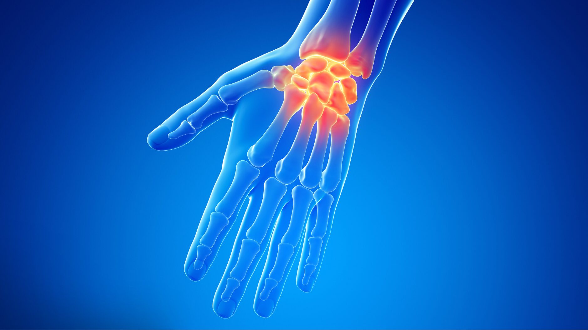 X-Ray image of a hand radiating pain for Louisiana Orthopaedic Specialists.